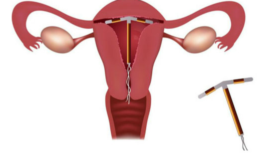همه چیز درباره آی یو دی IUD