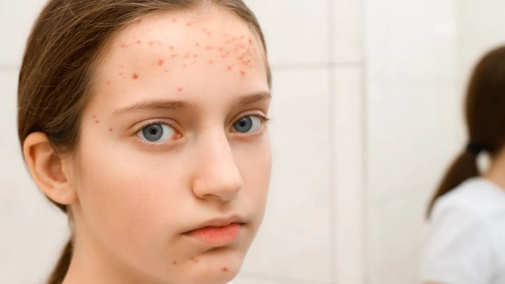 با جوش صورت نوجوانان چه کنیم؟