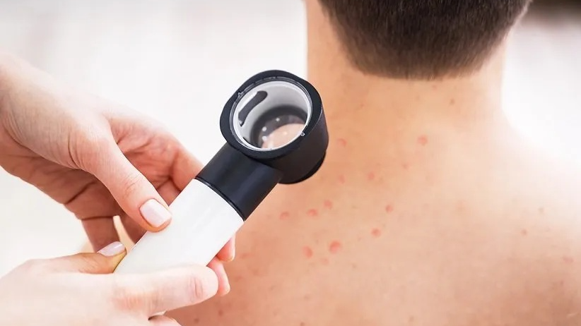 چگونه از ایجاد جوش روی کمر و سینه جلوگیری کنیم؟