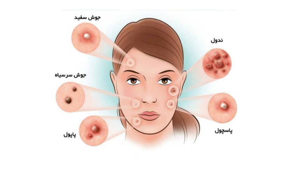 نحوه از بردن انواع آکنه و جوش
