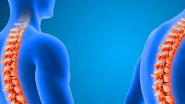 ورزشهای اصلاحی برای کاهش قوز کمر