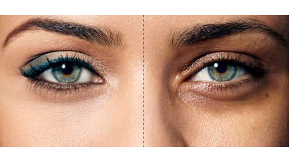 بهترین درمانهای خانگی برای سیاهی زیر چشم