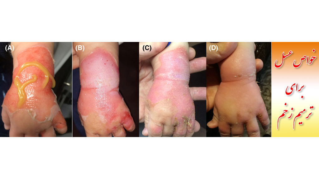 خواص عسل برای ترمیم زخم