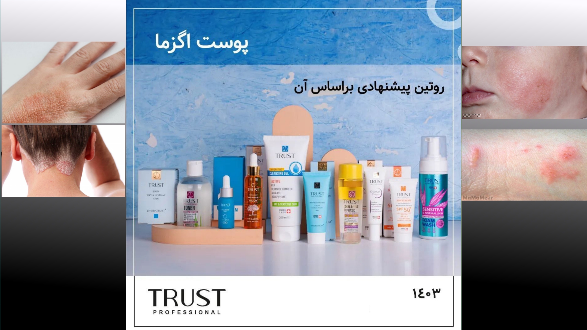 اگزما و روتین پوستی مناسب آن