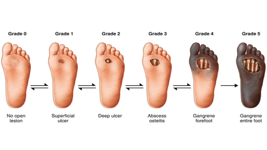 زخم‌های دیابتی و انواع درمان آن‌ها