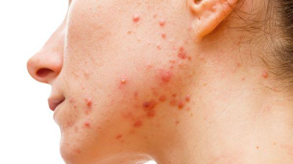 آیا گلیکولیک اسید باعث برون ریزی می‌شود؟ علت و راه‌های پیشگیری