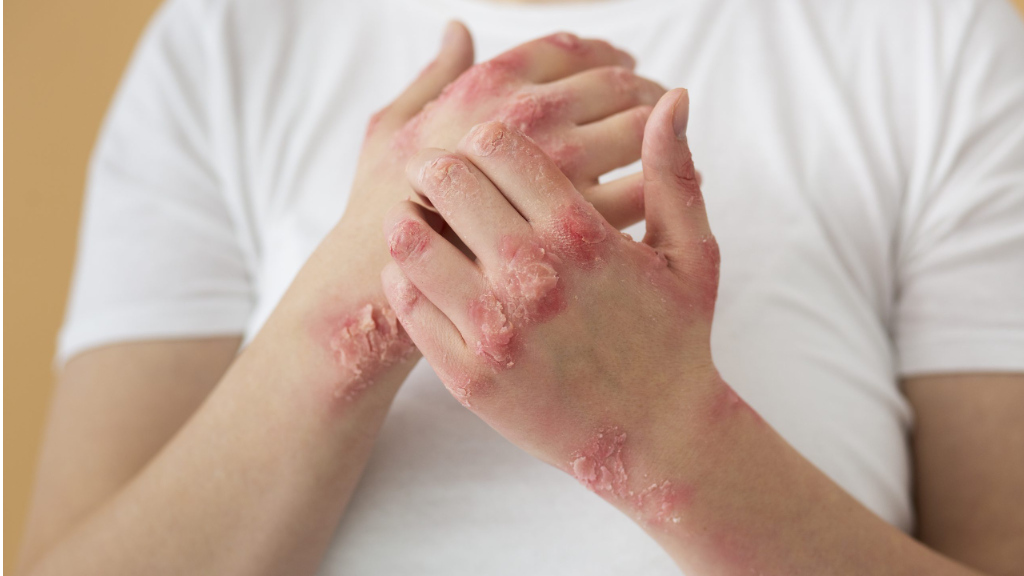 اگزما (Eczema): همه چیز درباره بیماری پوستی  و روش‌های درمان