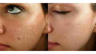 مراحل مراقبت از پوست های جوش دار